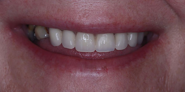 Partial denture - treatment results